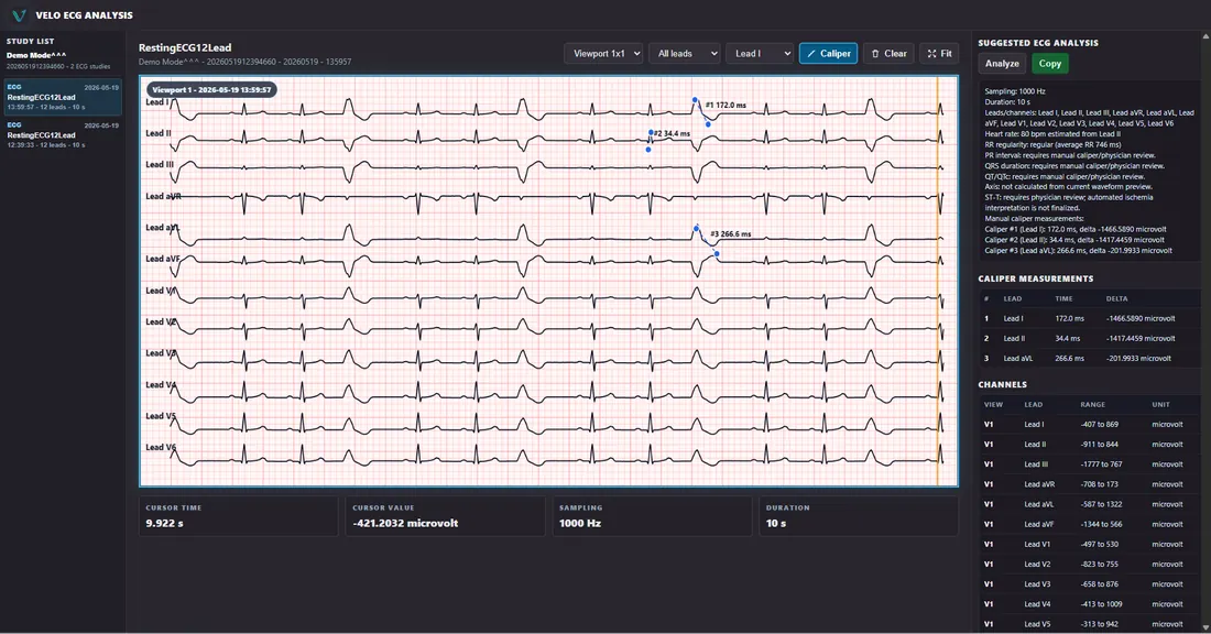 VELO ECG Analysis - AI-Powered Detection
